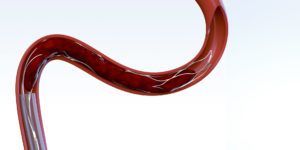 pRESET Thrombectomy Device by phenox