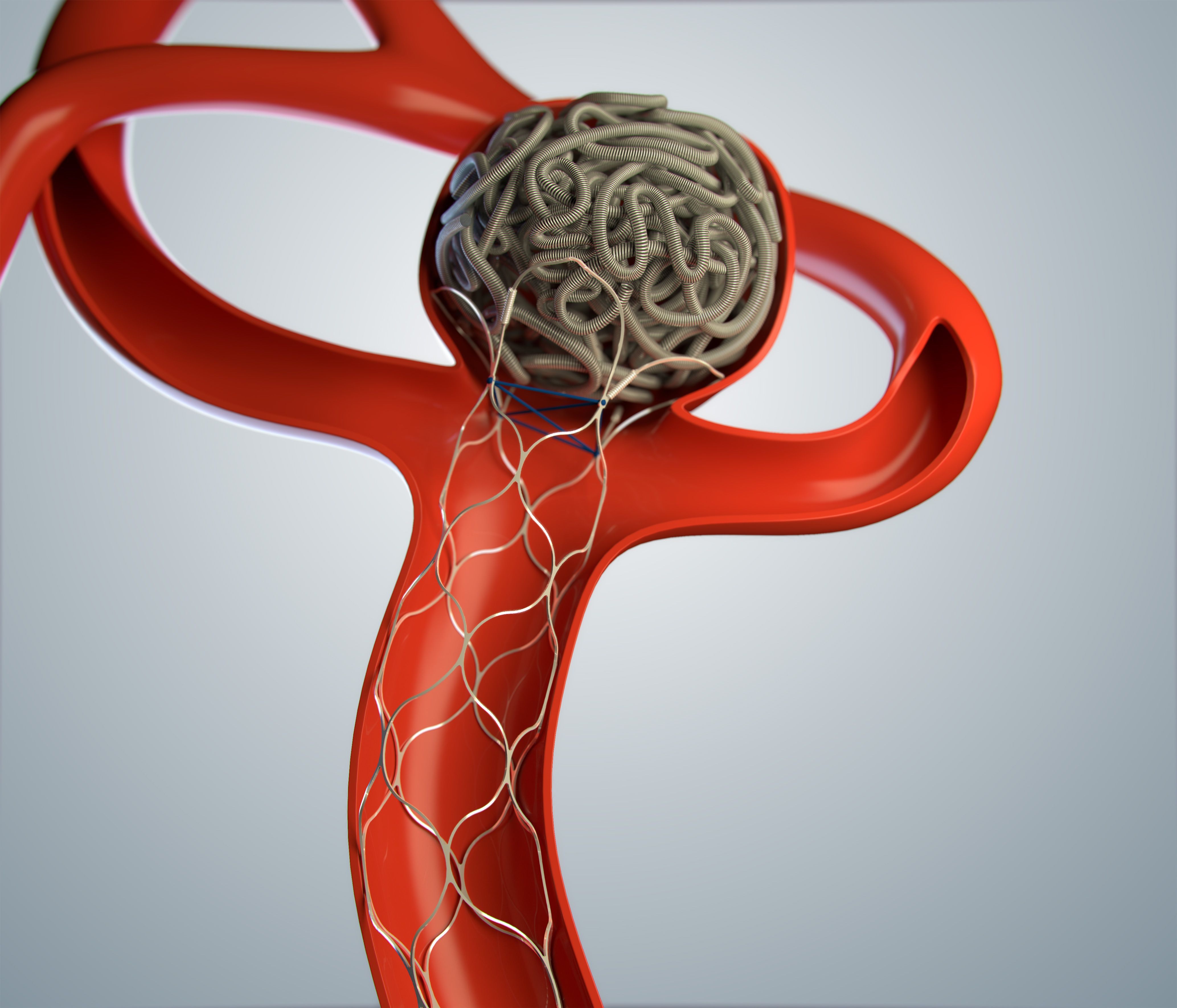 Embolization Inc. Reaches 125 Implants with Polymer-Based Coil