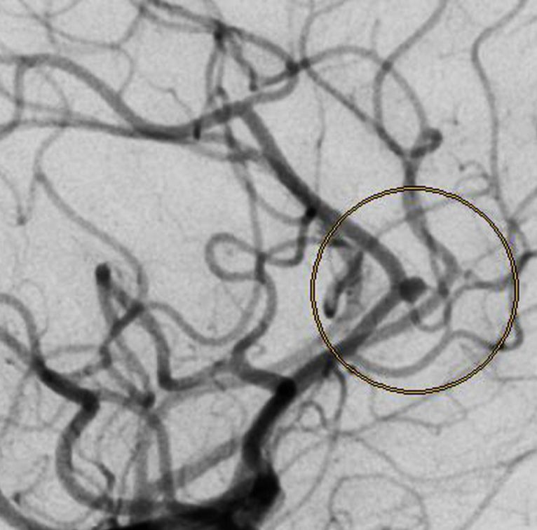 phenox will start development of a new implant for treatment of Sidewall Aneurysms soon